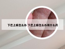 下巴上癣怎么办 下巴上癣怎么办用什么药