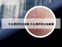 什么草药可以治癣 什么草药可以治癣病