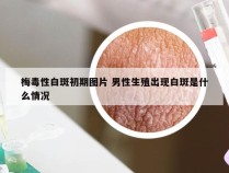 梅毒性白斑初期图片 男性生殖出现白斑是什么情况