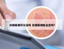 白颠疯病可以治吗 白颠疯病能治愈吗?