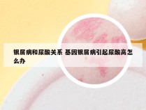 银屑病和尿酸关系 基因银屑病引起尿酸高怎么办