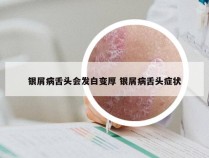 银屑病舌头会发白变厚 银屑病舌头症状