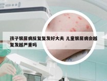 孩子银屑病反复复发好大夫 儿童银屑病会越复发越严重吗