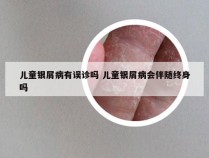 儿童银屑病有误诊吗 儿童银屑病会伴随终身吗