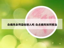 白癜风会传染给别人吗 白点癫风如何根治