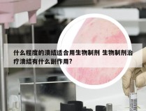 什么程度的溃结适合用生物制剂 生物制剂治疗溃结有什么副作用?