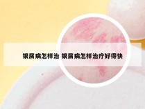 银屑病怎样治 银屑病怎样治疗好得快