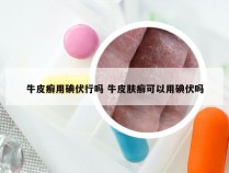 牛皮癣用碘伏行吗 牛皮肤癣可以用碘伏吗