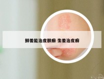 鲜姜能治皮肤癣 生姜治皮癣