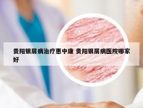 贵阳银屑病治疗惠中康 贵阳银屑病医院哪家好