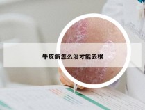 牛皮癣怎么治才能去根