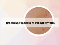 有牛皮癣可以吃春笋吗 牛皮肤癣能吃竹笋吗