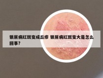 银屑病红斑变成丘疹 银屑病红斑变大是怎么回事?