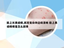 脸上长黑痣痒,抓完变白块边缘清晰 脸上黑痣痒痒是怎么回事