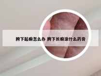 胯下起癣怎么办 胯下长癣涂什么药膏