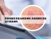 夫西地酸乳膏能治银屑病吗 夫西地酸乳膏能治疗银屑病吗