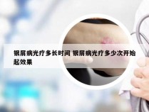 银屑病光疗多长时间 银屑病光疗多少次开始起效果