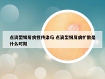 点滴型银屑病性传染吗 点滴型银屑病扩散是什么时期