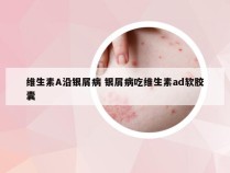 维生素A沿银屑病 银屑病吃维生素ad软胶囊