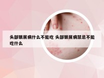 头部银屑病什么不能吃 头部银屑病禁忌不能吃什么