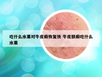 吃什么水果对牛皮癣恢复快 牛皮肤癣吃什么水果