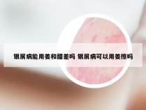 银屑病能用姜和醋差吗 银屑病可以用姜擦吗