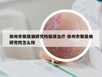 郑州市银屑病研究所输液治疗 郑州市银屑病研究院怎么样