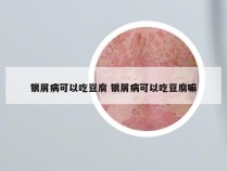 银屑病可以吃豆腐 银屑病可以吃豆腐嘛