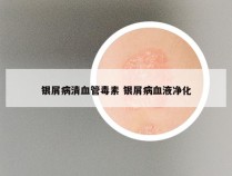 银屑病清血管毒素 银屑病血液净化