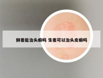 鲜姜能治头癣吗 生姜可以治头皮癣吗