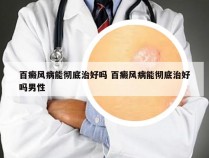 百癜风病能彻底治好吗 百癜风病能彻底治好吗男性