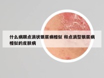 什么病跟点滴状银屑病相似 和点滴型银屑病相似的皮肤病