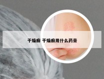 干燥癣 干燥癣用什么药膏