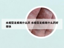 水疱型足癣用什么药 水疱型足癣用什么药好得快