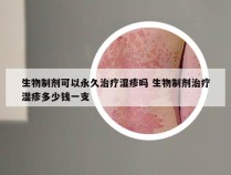 生物制剂可以永久治疗湿疹吗 生物制剂治疗湿疹多少钱一支