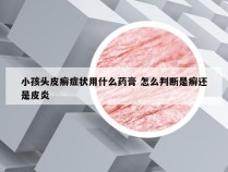 小孩头皮癣症状用什么药膏 怎么判断是癣还是皮炎