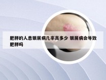 肥胖的人患银屑病几率高多少 银屑病会导致肥胖吗