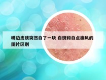 嘴边皮肤突然白了一块 白斑和白点癫风的 图片区别