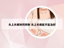 头上长癣如何抑制 头上长癣能不能治好