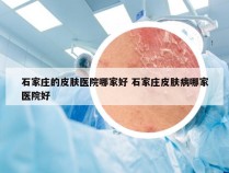 石家庄的皮肤医院哪家好 石家庄皮肤病哪家医院好