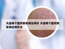 大连哪个医院银屑病治得好 大连哪个医院银屑病治得好点