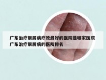 广东治疗银屑病疗效最好的医院是哪家医院 广东治疗银屑病的医院排名