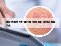 银屑病治着咋时好时坏 银屑病好转的迹象是什么