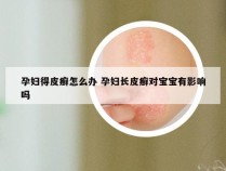 孕妇得皮癣怎么办 孕妇长皮癣对宝宝有影响吗