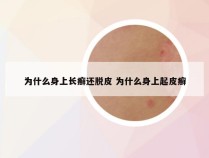 为什么身上长癣还脱皮 为什么身上起皮癣