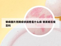 银癣图片初期症状园卷是什么癣 银屑癣百度百科