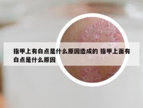 指甲上有白点是什么原因造成的 指甲上面有白点是什么原因