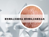 更年期头上长癣怎么 更年期头上长癣怎么办