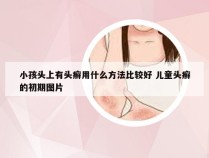 小孩头上有头癣用什么方法比较好 儿童头癣的初期图片