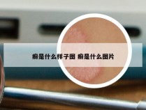 癣是什么样子图 癣是什么图片